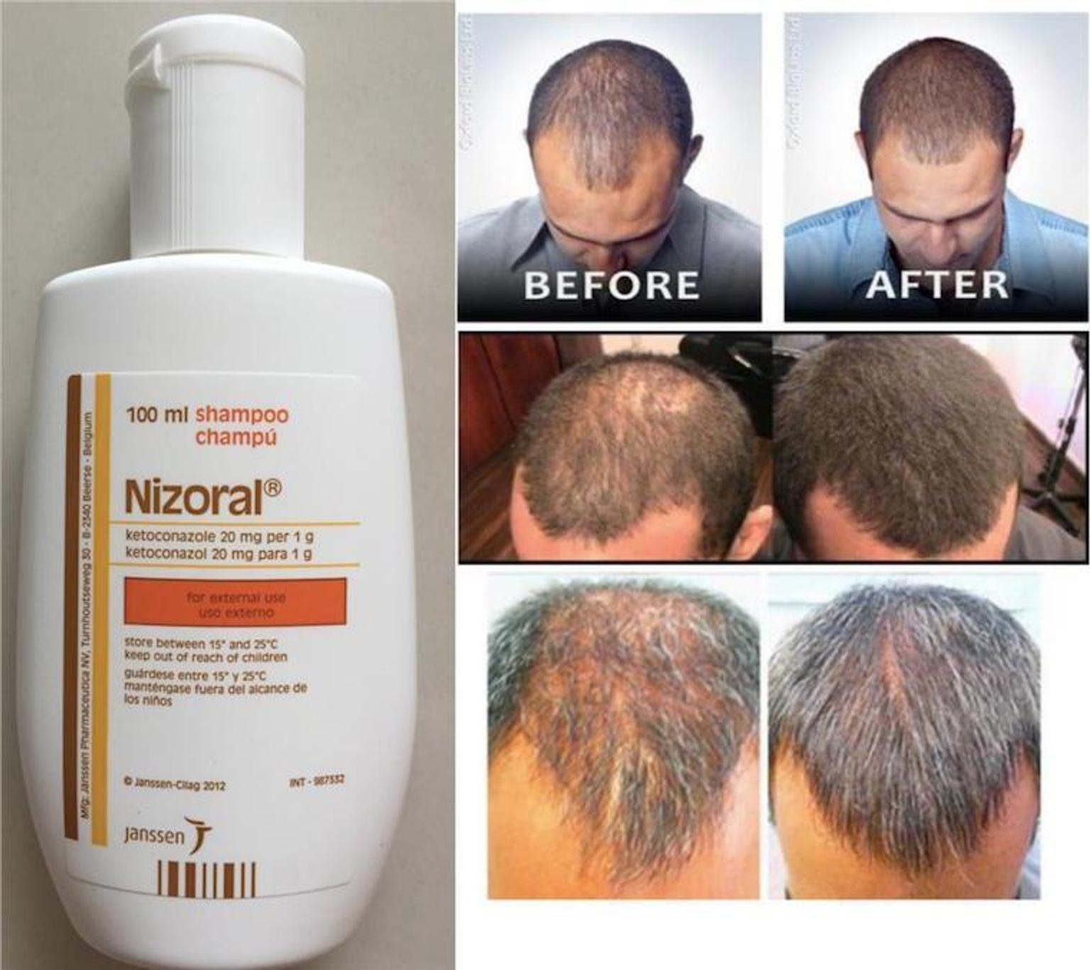  - what is metformin 500 mg used for | Nizoral shampoo for  skin conditions simply excellent